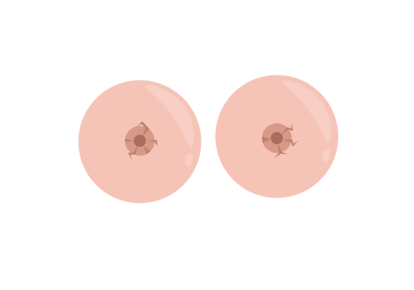 Two pink breasts with brown cracks on the nipples.