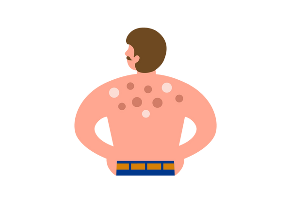 9 Causes for Bumps on Back | What You Need to Know | Buoy