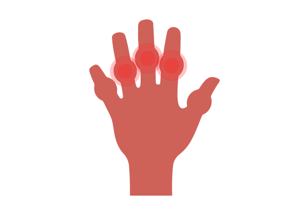 An illustration of a hand with outstretched fingers. Each middle knuckle is swollen. Red concentric circles radiating from the three middle swollen knuckles show swelling. The rest of the hand is a medium-dark peach tone.