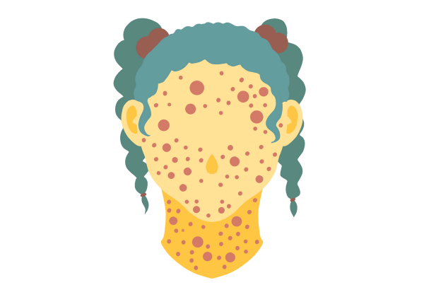 An illustration of a young girl from the neck up with a measles rash. She has yellow skin and a small teardrop-shaped nose. Her skin is covered in red spots of varying sizes. Her hair is medium green and tied up in two braided pigtails with brown bobble hair ties.