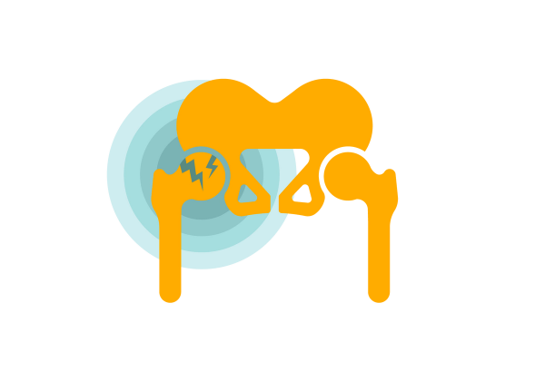 Yellow hip bones. The left one has blue lightning bolt fractures and blue concentric circles emanate from it.