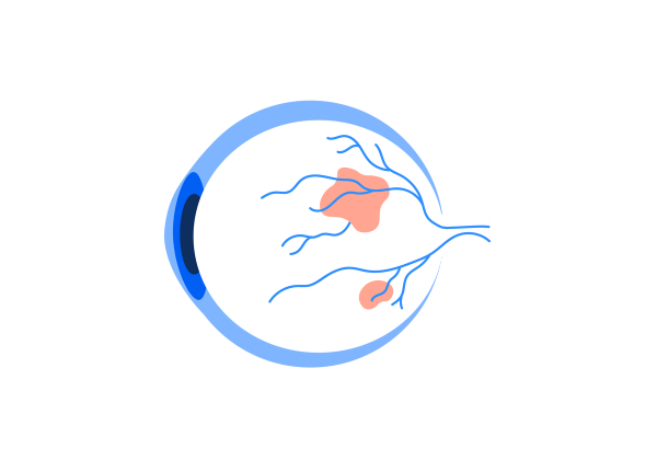 An illustration of a side view of an eyeball. The eyeball is white with medium blue veins running through it from the back. A light blue outline surrounds the front of the eyeball, and a medium blue iris and dark blue pupil are visible from the side. Two red blotches are visible on the white of the eyeball.