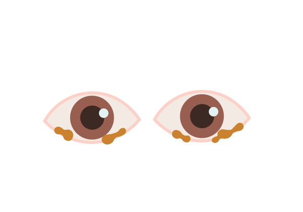 An illustration of two pink eyes. The irises are medium brown and the pupils are dark brown. Yellow-brown clumps of discharge are on the bottom eyelid.