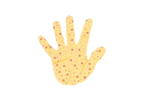 An illustration of a child's palm. The skin is yellow and the fingers are outstretched. The palm and fingers are covered in a distinctive red rash comprised of red dots of varying size, a common symptom of Coxsackievirus.