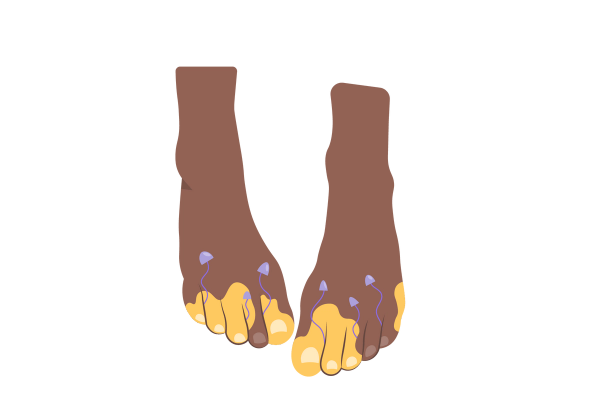 An illustration of two dark brown peach-toned feet from a partially top-down view. There are yellow splotches across most of the toes, and small purple mushrooms growing upwards from between the toes.