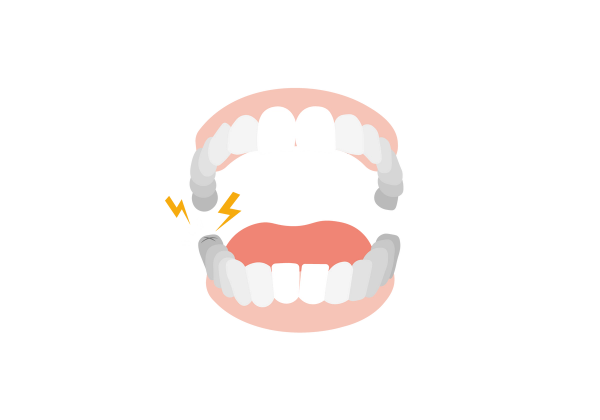 An illustration of an open jaw showing teeth, gums, and the tongue. The tooth closest to the back left of the bottom jaw has a small "x" shape on it, and two yellow lightning bolts come from the tooth as well as three small white lines. The teeth are white and become darker shades of grey the deeper in the jaw they are. The gums are light pink and the tongue is darker pink.