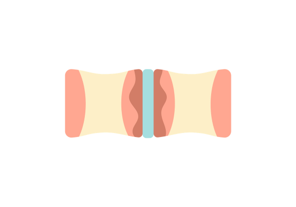 An inflammatory arthritis 