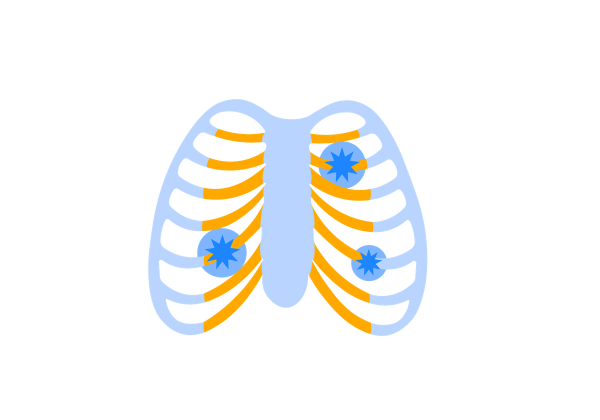 Une cage thoracique bleu clair avec des sections jaunes près du sternum. Trois points bleus en forme d'étoile entourés de cercles bleu plus clair se trouvent sur les sections jaunes.