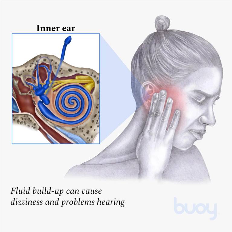 meniere's syndrome one ear plugged up and ringing
