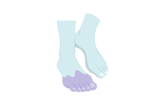 Une illustration de deux pieds vert clair, à mi-marche. Il y a une tache violet clair sur les orteils et la plante du pied au premier plan. Quatre lignes vert clair proviennent de la zone violette.