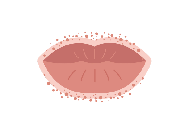 Rash around the outside of the lips.