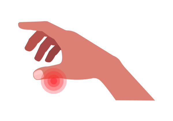 An illustration of a side angle of a right hand facing down and fingers pointing left. Red concentric circles show pain near the base of the fingernail. The skin is medium-dark peach toned, and the fingernail is a lighter pink. The rest of the fingers are relaxed naturally.