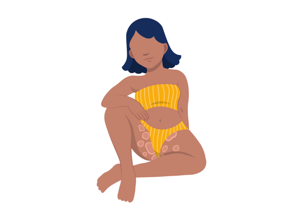 An illustration of a woman in a bathing suit sitting with her left leg bent in front of her on the ground and her right leg bent upwards. There are round rosy blob-shapes with lighter pink borders around her crotch and inner thighs. The rest of her skin is medium-dark warm chocolate-toned, her hair is a short dark blue bob, and she is wearing a yellow and white-striped bathing suit.