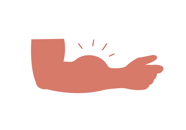 An arm bent at the elbow with a large bump on the forearm. Four red lines emanate from the bump.