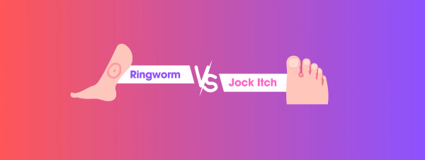 Ringworm vs Jock Itch