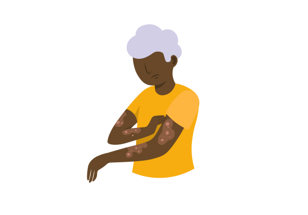 An illustration of a frowning woman from the waist up with her left arm bent in front of her and her right hand scratching at medium brown blotches with pink circles within the splotches on her left arm. She has dark brown skin and short, curly light purple hair. She is wearing a yellow short-sleeved t-shirt.