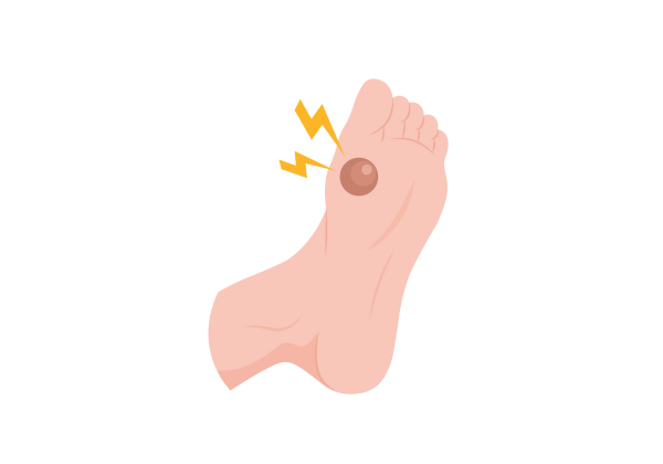 An illustration of the bottom of a light peach-toned foot from a three-quarter angle. There is a large red round blister on the ball of the foot below the big toe. Two yellow lightning bolts come from the spot.