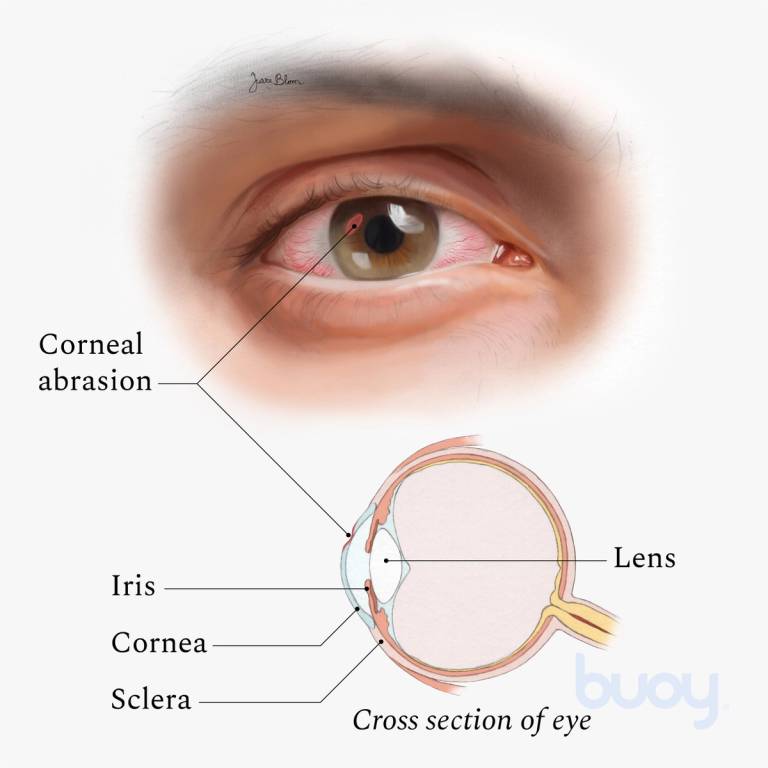 What Causes Scratched Eye & How to Treat It | Buoy What Causes Scratched Eye & How to Treat It | Buoy
