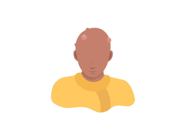 An illustration of a person with their head tilted slightly downward. There are big bumps on their scalp. They are wearing a yellow shirt.