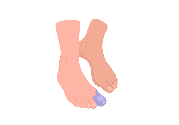 An illustration of two light peach-toned feet mid-step. The foot in front has a purple splotch on the big toe. The back foot only has the toes and ball of the foot on the ground.