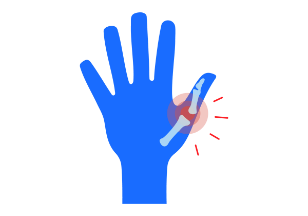 Eine Illustration einer blauen linken Hand mit ausgestreckten Fingern. Durch die Haut des Daumens sind hellblaue Knochen sichtbar, zwischen zwei davon klafft eine große Lücke. Drei rote konzentrische Kreise entstehen aus der Lücke zwischen den Knochen, und vier rote Linien betonen den Kreis.