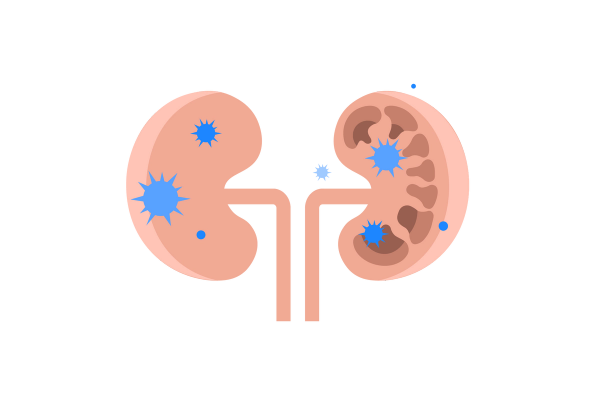 Two pink kidneys. The left one has blue bacteria, the right side has mushroom-shaped holes with blue bacteria over them.