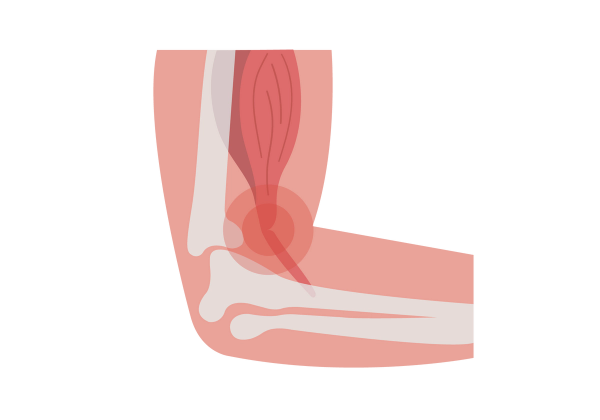 An elbow with a view of the bones and tendons. The tendon is split near the elbow and red concentric circles emanate from it.