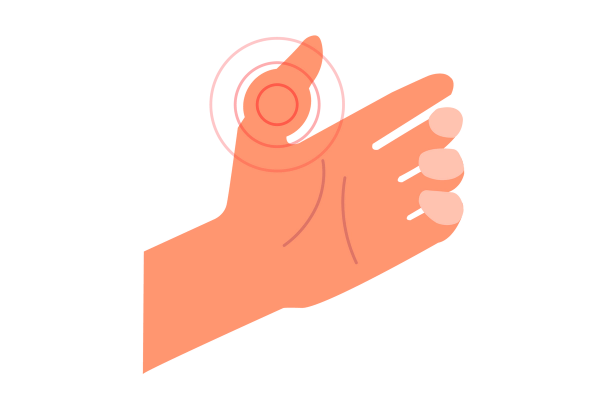 An illustration of a hand with the palm up. The fingers are curled naturally and the thumb is sticking up. There is a large swollen area on the thumb, and three red concentric circles surround it, emphasizing the swelling. The rest of the hand is a light-medium peach tone.