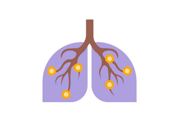 Pulmões com inflamação nas vias respiratórias