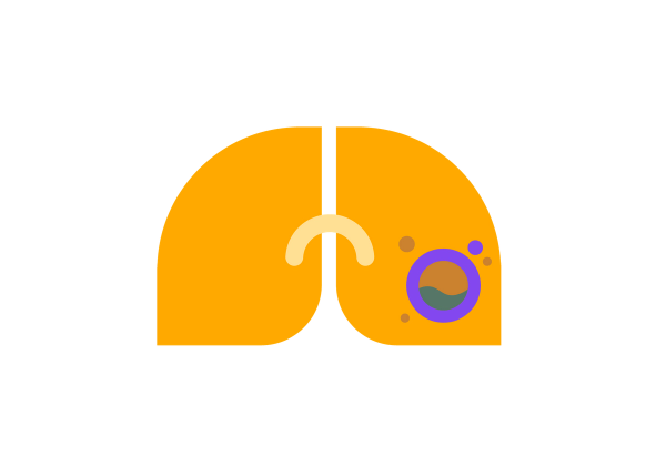 Lungs with a bacterial infection on one side.