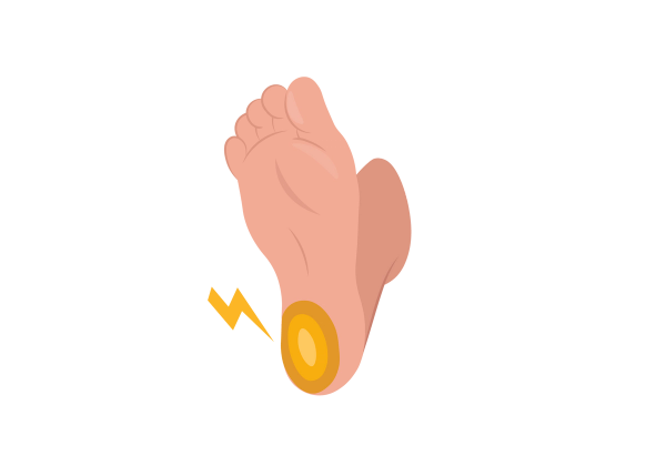 An illustration of a light peach-toned foot, showing the sole and heel. The heel has yellow concentric ovals lightening towards the center, and one yellow lightning bolt comes from the heel.