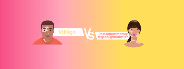 Vitiligo vs. Post-inflammatory Hypopigmentation